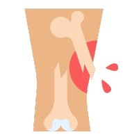 Maxillo Facial Fracture